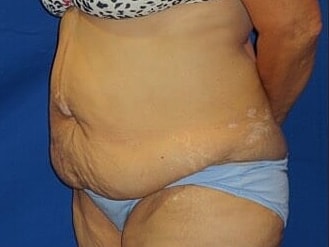 Tummy Tuck Before & After