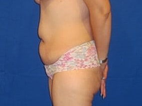 Tummy Tuck Before & After