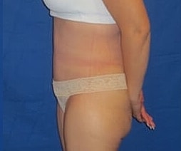 Tummy Tuck Before & After