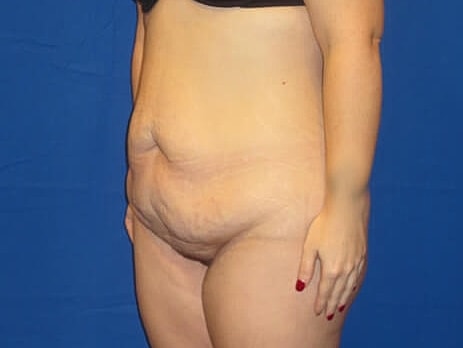 Tummy Tuck Before & After