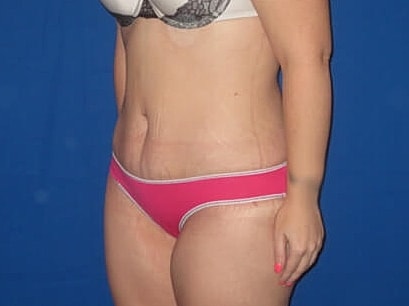 Tummy Tuck Before & After