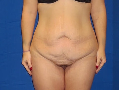 Tummy Tuck Before & After
