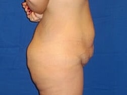 Tummy Tuck Before & After