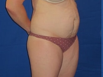 Tummy Tuck Before & After