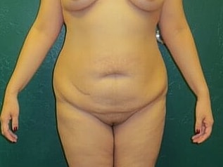 Tummy Tuck Before & After