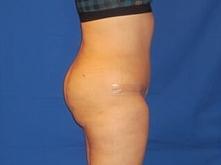 Tummy Tuck Before & After