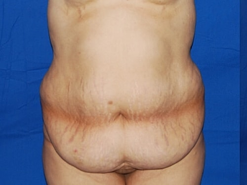 Tummy Tuck Before & After
