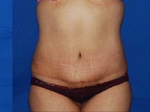 Tummy Tuck Before & After