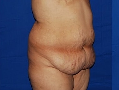 Tummy Tuck Before & After