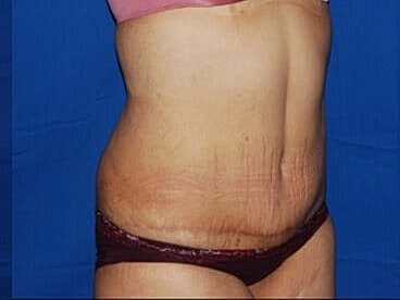 Tummy Tuck Before & After