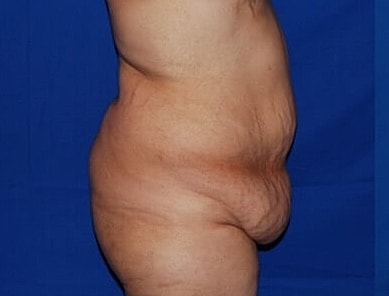 Tummy Tuck Before & After