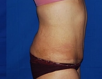 Tummy Tuck Before & After