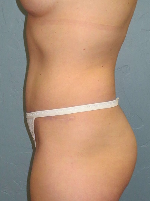 Tummy Tuck Before & After