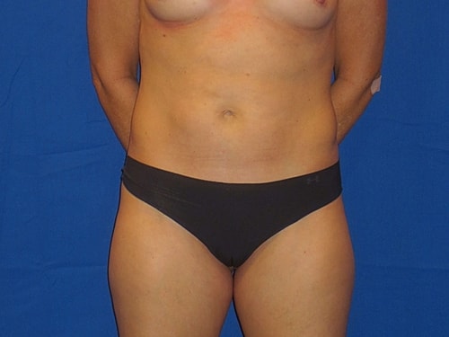 Tummy Tuck Before & After