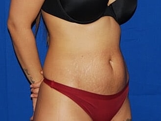 Tummy Tuck Before & After