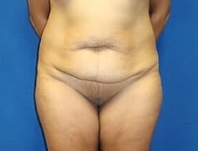 Tummy Tuck Before & After