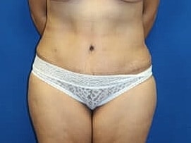 Tummy Tuck Before & After