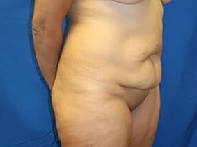 Tummy Tuck Before & After