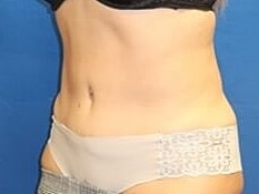 Tummy Tuck Before & After