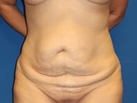Tummy Tuck Before & After
