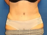 Tummy Tuck Before & After