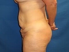 Tummy Tuck Before & After