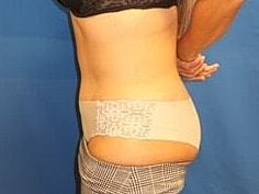 Tummy Tuck Before & After