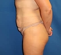 Tummy Tuck Before & After