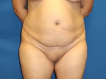 Tummy Tuck Before & After