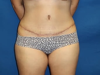 Tummy Tuck Before & After