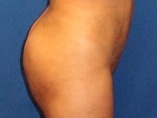 Brazilian Butt Lift Before & After