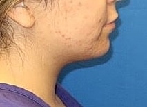 Liposuction Before & After