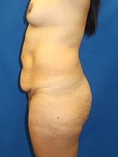 Liposuction Before & After