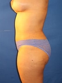 Liposuction Before & After