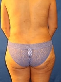 Liposuction Before & After