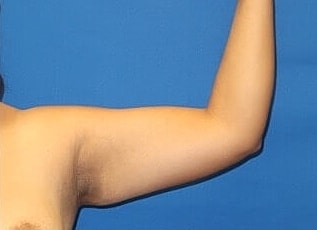 Liposuction Before & After