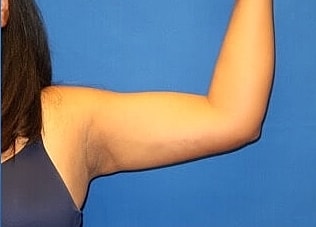 Liposuction Before & After