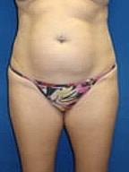 Liposuction Before & After