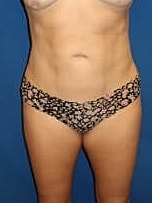 Liposuction Before & After