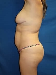 Liposuction Before & After