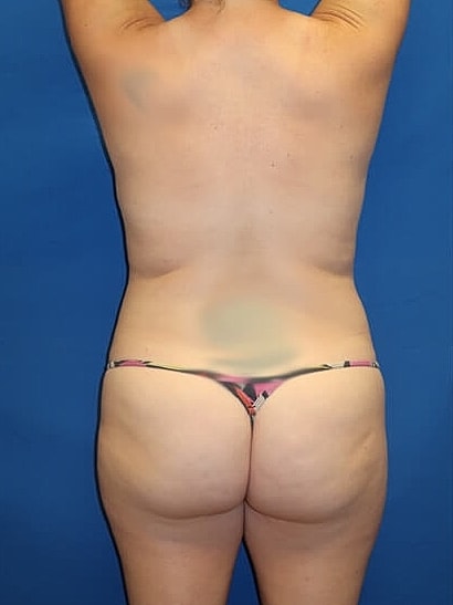 Liposuction Before & After