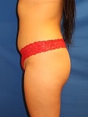 Liposuction Before & After