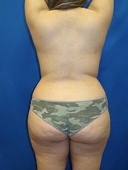 Liposuction Before & After