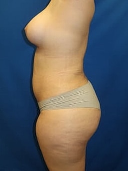 Liposuction Before & After