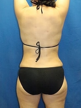 Liposuction Before & After