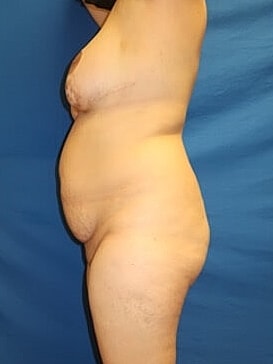 Liposuction Before & After
