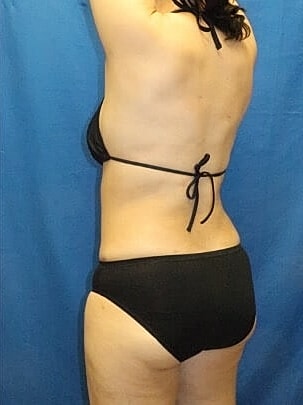 Liposuction Before & After