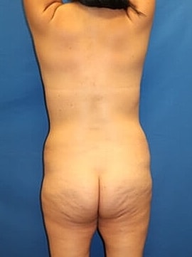 Liposuction Before & After