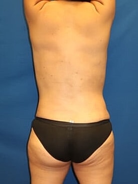Liposuction Before & After