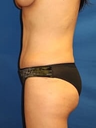 Liposuction Before & After